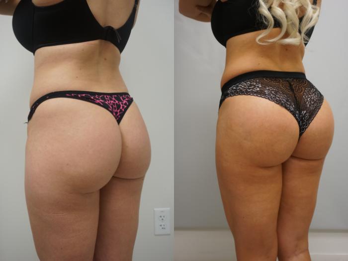 The 5 Best Ways to Get a Bigger Butt Fast