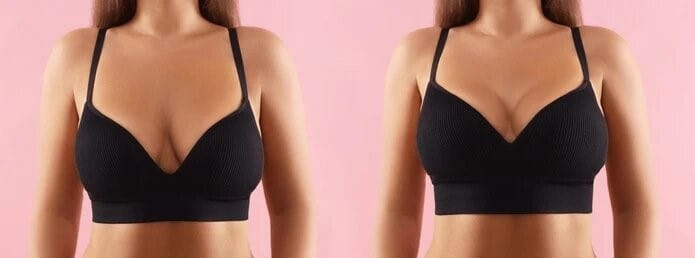 Treating Saggy Breasts