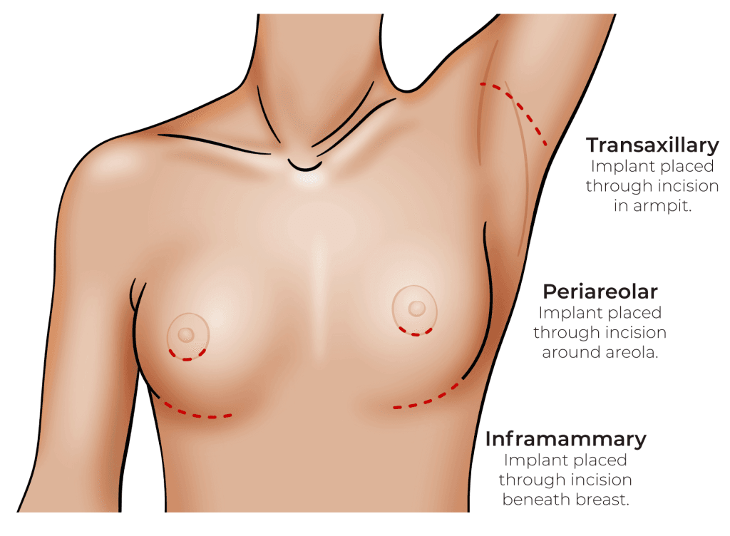 What are the effective methods for breast enlargement?