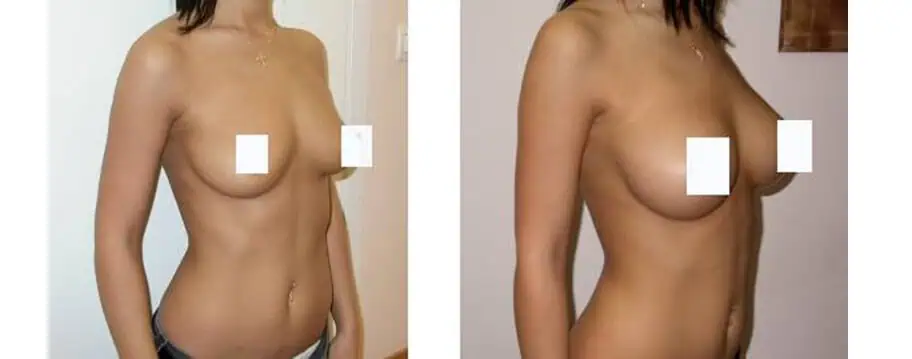 What are the effective methods for breast enlargement?