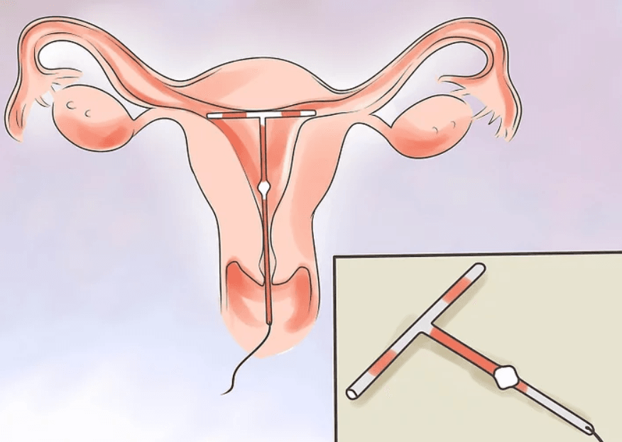 Easy ways to medically and naturally prevent an unwanted pregnancy