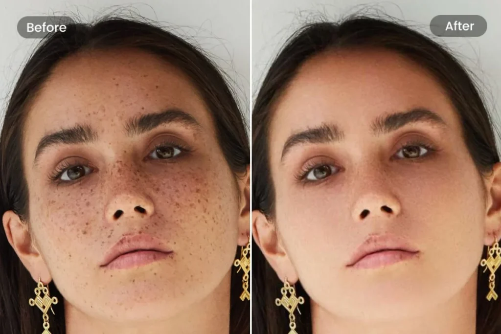 How to Remove Dark Spots from Pimples