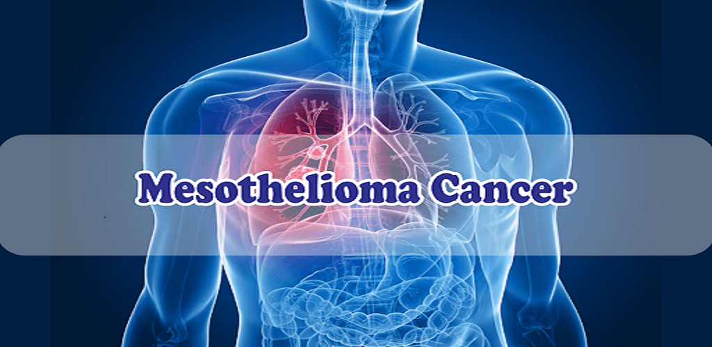 Mesothelioma Cancer