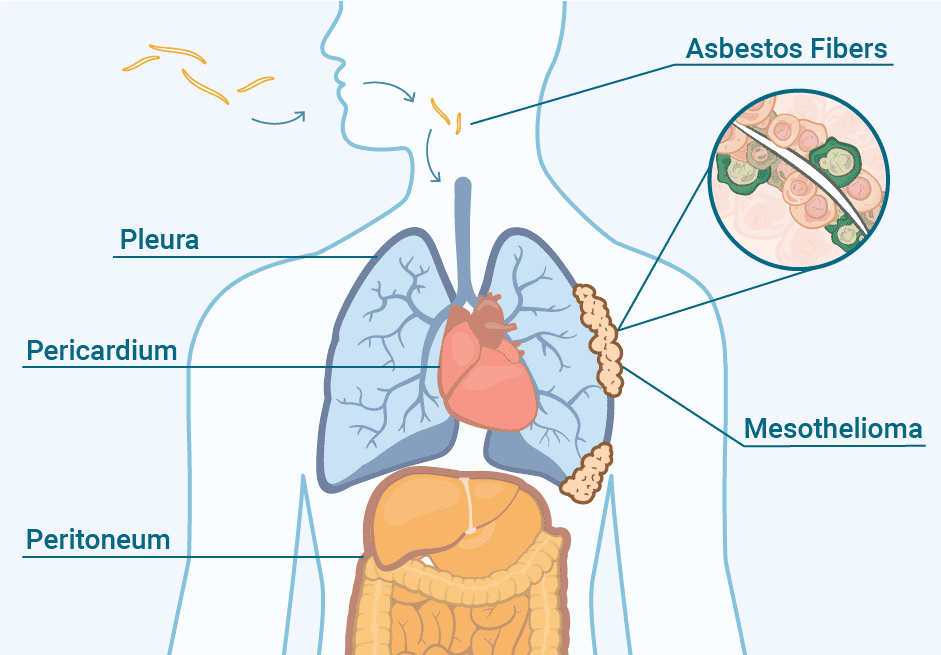 Mesothelioma Cancer